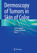 Dermoscopy of Tumors in Skin of Color