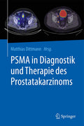PSMA in Diagnostik und Therapie des Prostatakarzinoms